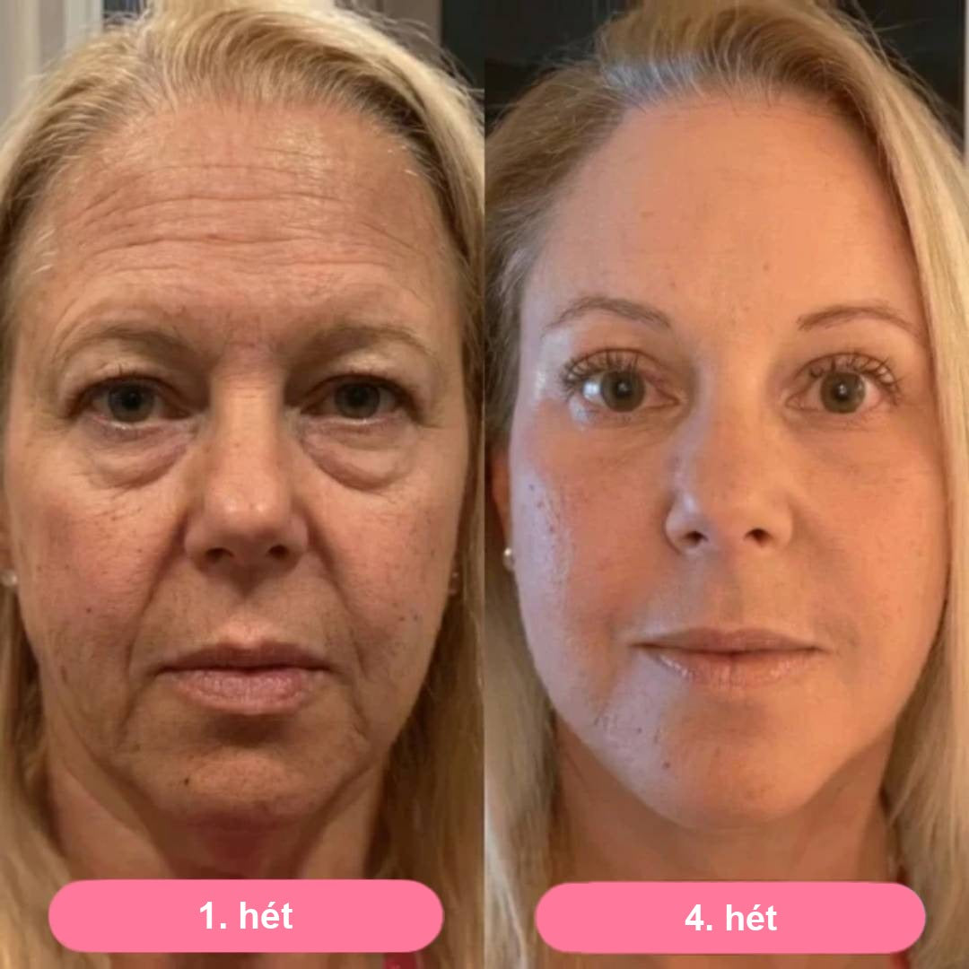 Serum Collagen